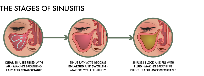 How To Sleep With Sinusitis Sinusitis And Sleep Woolroom